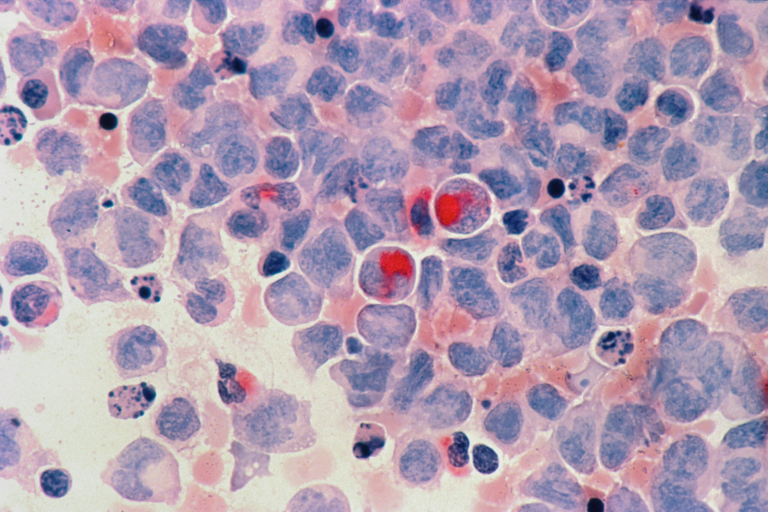 Personalising Treatment for Europe’s most common Leukaemia – new Sucess Story published
